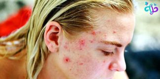 Best Facial Wash For Cystic Acne